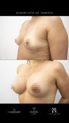 Mamoplastia de aumento - Dra. Nicole Echeverry