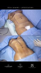 Lipoescultura - Dra. Nicole Echeverry