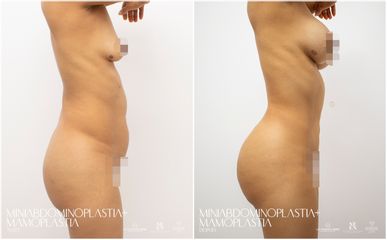 Abdominoplastia - Dra. Nicole Echeverry