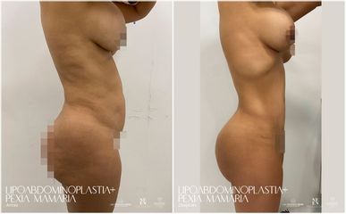 Abdominoplastia - Dra. Nicole Echeverry
