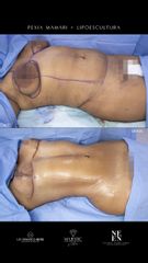 Lipoescultura - Dra. Nicole Echeverry