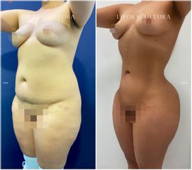 Lipoescultura - Dra. Nicole Echeverry