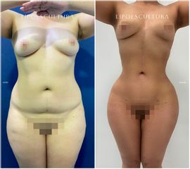 Lipoescultura - Dra. Nicole Echeverry