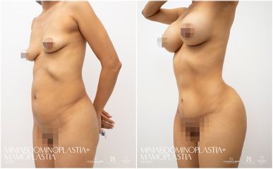 Abdominoplastia - Dra. Nicole Echeverry