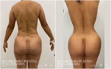 Abdominoplastia - Dra. Nicole Echeverry