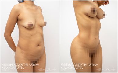Abdominoplastia - Dra. Nicole Echeverry
