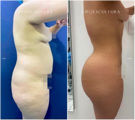 Lipoescultura - Dra. Nicole Echeverry