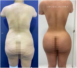 Lipoescultura - Dra. Nicole Echeverry