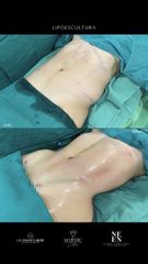 Lipoescultura - Dra. Nicole Echeverry