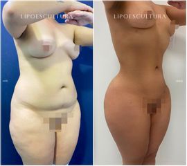 Lipoescultura - Dra. Nicole Echeverry
