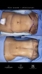 Lipoescultura - Dra. Nicole Echeverry