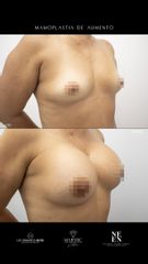 Mamoplastia de aumento - Dra. Nicole Echeverry