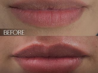 Aumento de labios antes y después - 869587