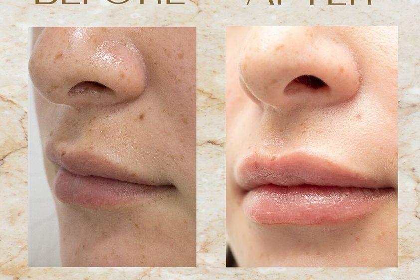 Aumento de labios antes y después - 869588