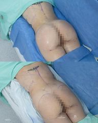 Gluteoplastia - Dra. Nicole Echeverry