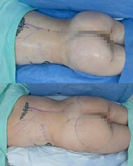 Gluteoplastia - Dra. Nicole Echeverry