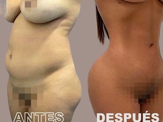 Lipoescultura - 869591