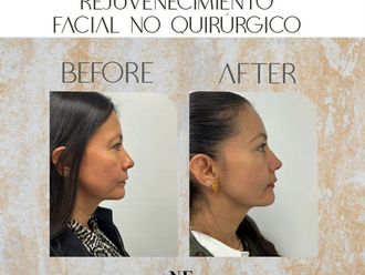 Rejuvenecimiento facial antes y después - 869600