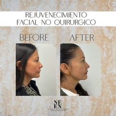 Rejuvenecimiento facial - Dra. Nicole Echeverry