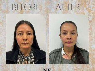 Rejuvenecimiento facial antes y después - 869601