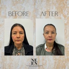 Rejuvenecimiento facial - Dra. Nicole Echeverry