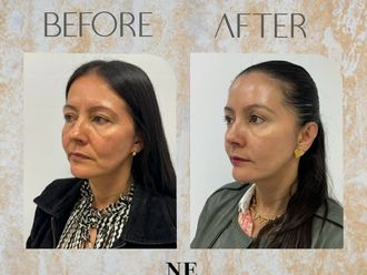 Rejuvenecimiento facial antes y después - 869602