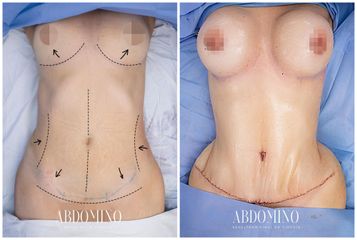 Abdominoplastia - Dra. Nicole Echeverry