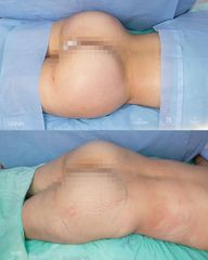 Gluteoplastia - Dra. Nicole Echeverry