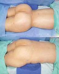 Gluteoplastia - Dra. Nicole Echeverry