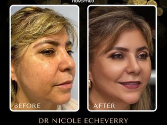 Lifting facial antes y después - 869939