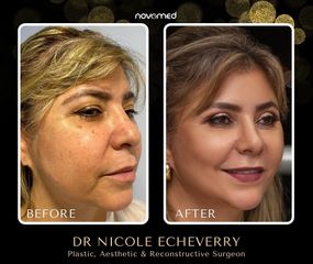 Lifting facial - Dra. Nicole Echeverry