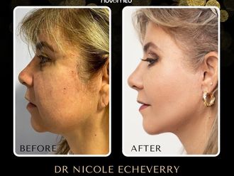 Lifting facial antes y después - 869940