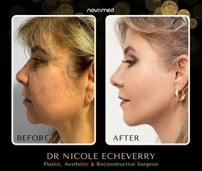 Lifting facial - Dra. Nicole Echeverry