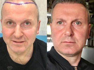 Alopecia antes y después - 873943