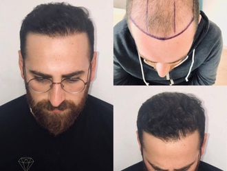 Alopecia antes y después - 873944