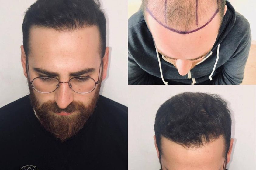 Alopecia antes y después - 873944