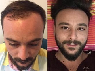 Alopecia antes y después - 873945
