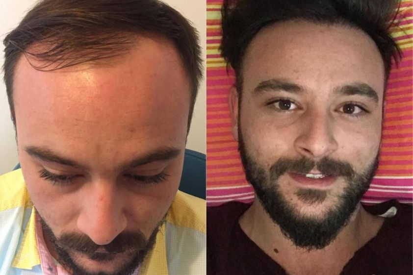 Alopecia antes y después - 873945