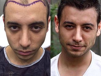 Alopecia antes y después - 873946