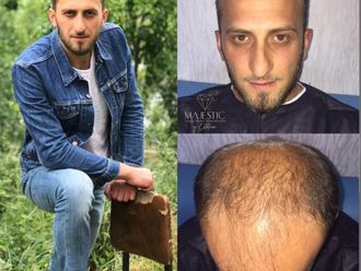 Alopecia antes y después - 873948