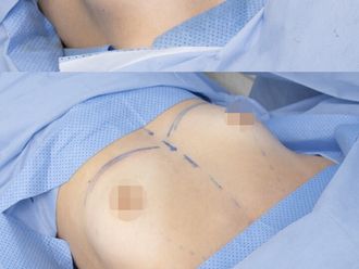 Mamoplastia de aumento antes y después - 879968