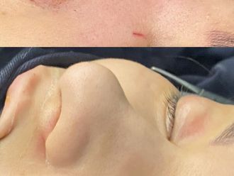 Rinoplastia antes y después - 879969