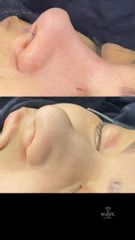 Rinoplastia