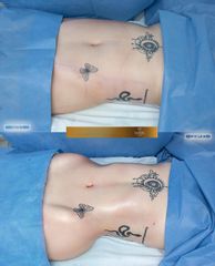 Lipoescultura