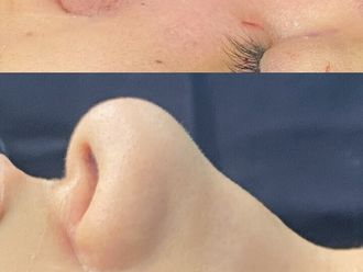Rinoplastia antes y después - 879980