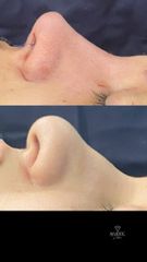 Rinoplastia