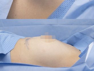 Mamoplastia de aumento antes y después - 879981