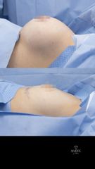 Mamoplastia de aumento