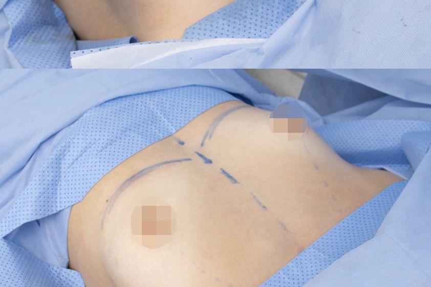 Mamoplastia de aumento antes y después - 879982