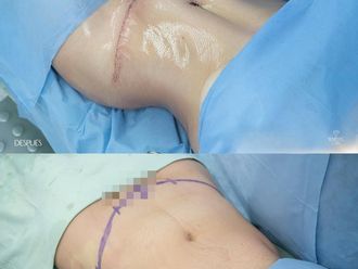 Abdominoplastia antes y después - 879983